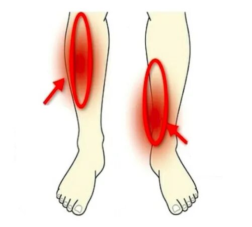 Почему болит низ ноги. Воспаление надкостницы голени (шинсплинт). Периостит надкостницы голени.