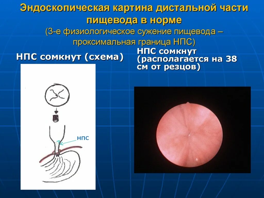 Нормальный пищевод. Эндоскопическая анатомия пищевода. Пищевод человека эндоскопия. Анатомические сужения пищевода.