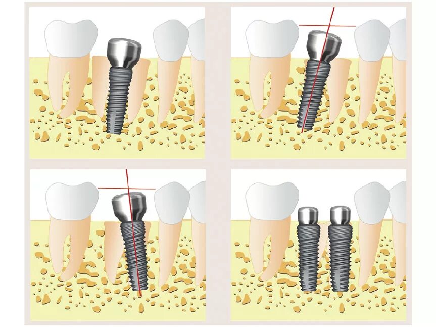 Этапы имплантации зуба абатмент. Штрауманн формирователь десны. Вкручивающиеся зубы импланты. Костный материал Штрауман. 3 зуба установить