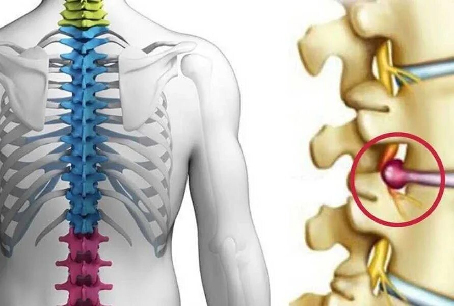 Сильные боли грыжа позвоночника. Межпозвоночная грыжа грудного отдела симптомы. Грыжи дисков поясничного отдела позвоночника. Грыжа грудного отдела позвоночника т4. Межпозвонковая грыжа грудного отдела.