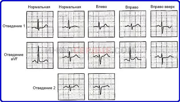 Сердце отклонено вправо. Отклонение электрической оси на ЭКГ. Отклонение электрической оси сердца влево на ЭКГ. Смещение электрической оси сердца влево на ЭКГ. Отклонение ЭОС вправо на ЭКГ.