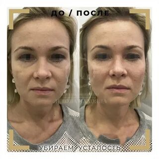 Заполнение борозды