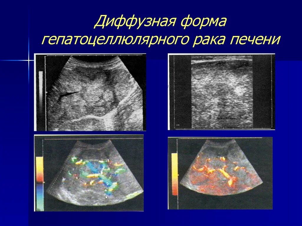 Диффузные образования. Гепатоцеллюлярная карцинома диффузная. очаговые поражения печени. очаговые образования в печени на узи.