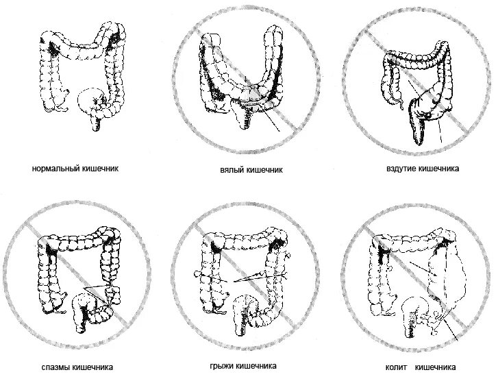 Ленивый кишечник самостоятельно без слабительного. Синдром ленивого кишечника.