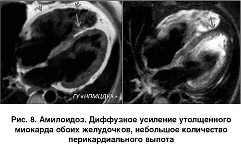 Амилоидоз миокарда