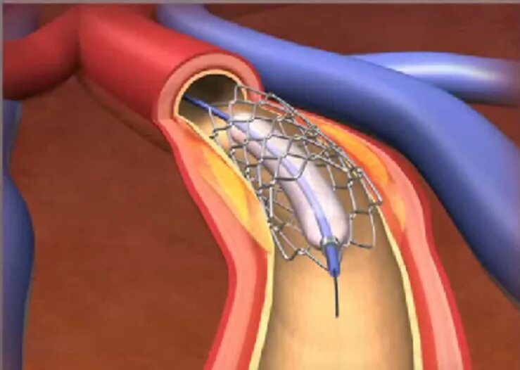 Стентирование видео. Стентирование коронарных артерий. Шунтирование сосудов сердца стент. Стентирование и аортокоронарное шунтирование. Коронарография стентирование.