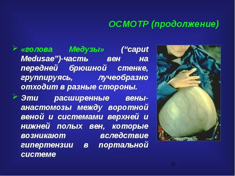 Варикозное расширение вен брюшной стенки. Варикозное расширение вен голова медузы. Синдром медузы. Варикозное расширение вен брюшной стенки. Бюст медузы горгоны бернини.