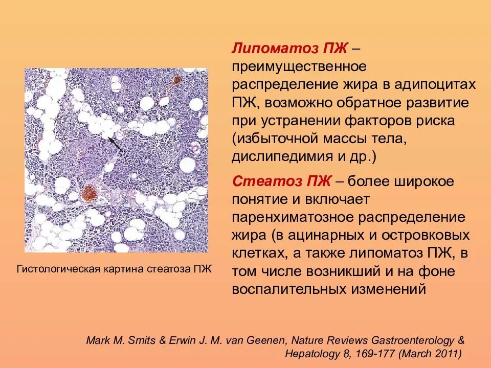 Липоматоз патологическая анатомия. Липоматоз липоматоз липоматоз. Хронический панкреатит липоматоз. Что такое стеатоз поджелудочной железы