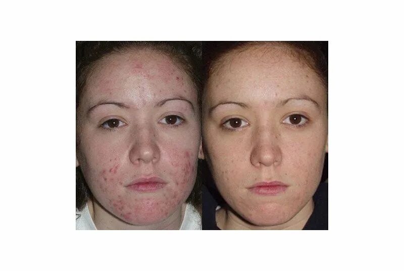 Лицо после пилингов отзывы. Лазерный карбоновый пилинг. Лицо после пилингов отзывы. Газожидкостный пилинг до и после. Ретиноловый пилинг до и после.