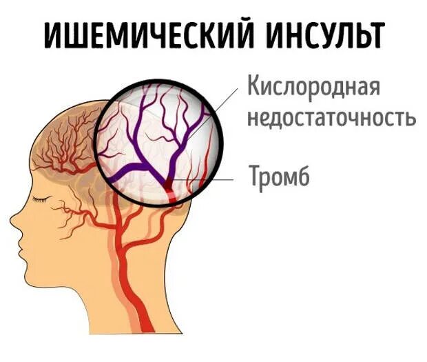 Лакунарный ишемический инсульт. Ишемический атеротромботический инсульт осложнения. Ишемический инсульт мозга. Ишемический инсульт картинки. Тромбы после инсульта