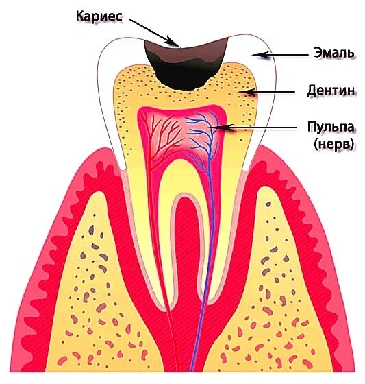 Витальная депульпация. Как понять что удалили нерв. Острый очаговый пульпит. Удаленный нерв зуба снимок. Как понять что удалили нерв.