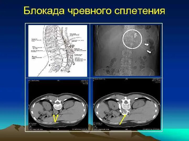 Блокада сплетения. Блокада чревного сплетения. Блокада солнечного сплетения. Нейролизис чревного сплетения. Блокада чревного сплетения техника.