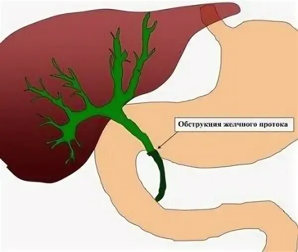 Застой желчного пузыря у взрослого симптомы. Закупорка желчных протоков. Холестаз желчь. Застой в желчных протоках.