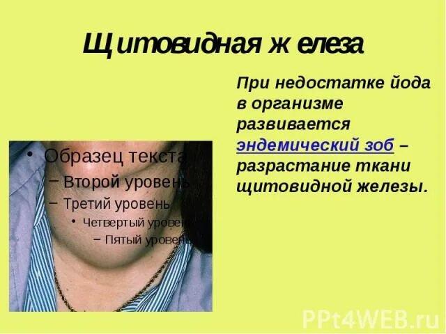 Тест йодом на недостаток йода. Недостаток йода щитовидка. Зоб щитовидной железы дефицит йода. Щитовидка при недостатке йода. При недостатке йода в организме развивается.