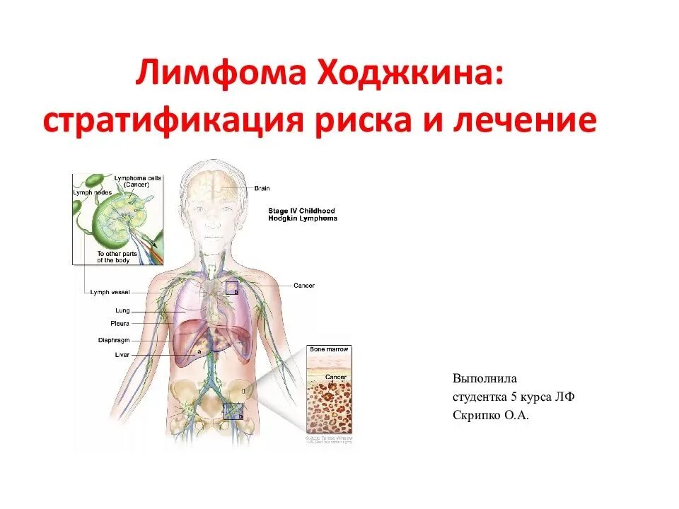 Причина заболевания лимфомой. В-симптомы при лимфоме Ходжкина. Лимфома 1 стадия симптомы.