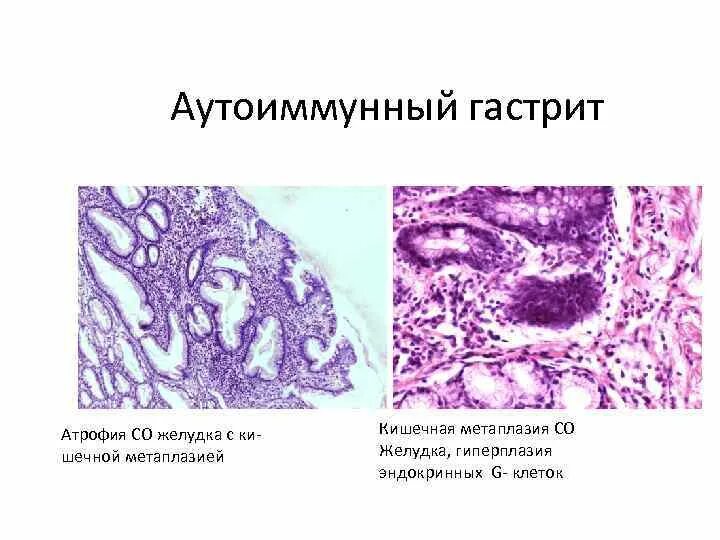 Аутоиммунный гастрит микропрепарат. Хронический атрофический гастрит гистология. Хронический атрофический гастрит патан. Очаговый атрофический гастрит. Атрофический гастрит патанатомия.
