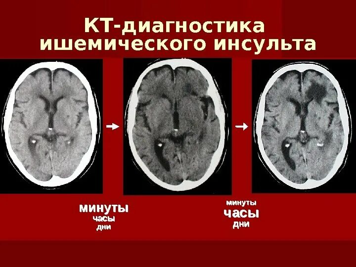 Периоды ОНМК по мрт. Ишемический инсульт морфология. Стадии ОНМК по плотности. Постинфарктные изменения головного мозга. Что такое ишемический инсульт головного мозга