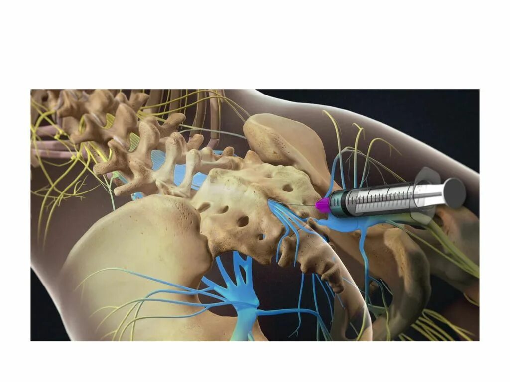 Паравертебральная поясничная блокада. Паравертебральная блокада пояснично-крестцовый. Паравертебральной блокадf. Лечебные блокады в неврологии. Блокады в неврологии в позвоночник.