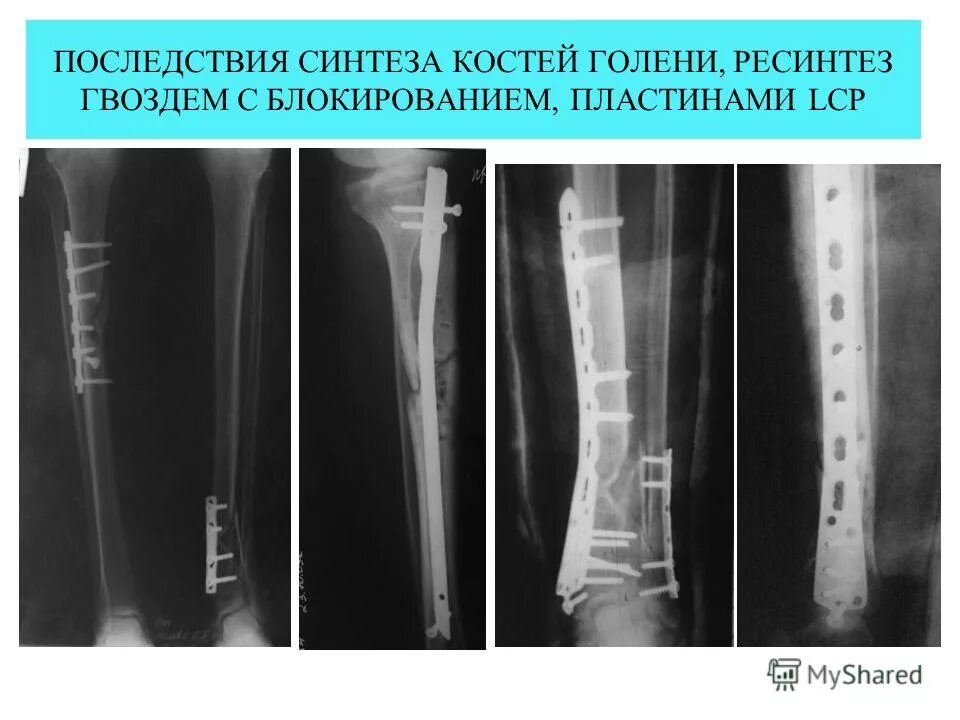 После операции на берцовой кости. Костей голени пластинами. Костная пластика голени.