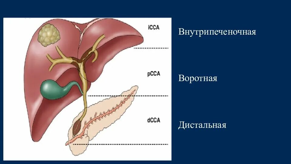 Отек желчного пузыря. Внутрипеченочный желчный проток. Опухоли желчных протоков и желчного пузыря. Онкология желчных протоков. Внутрипеченочный желчный пузырь.