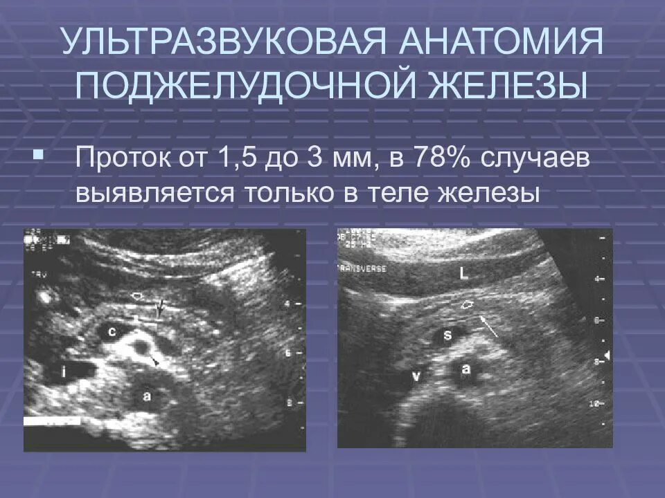 Ультрасонография поджелудочной железы. Вирсунгов проток поджелудочной железы УЗИ. Эхограмма поджелудочной железы. УЗИ поджелудочной железы измерение.