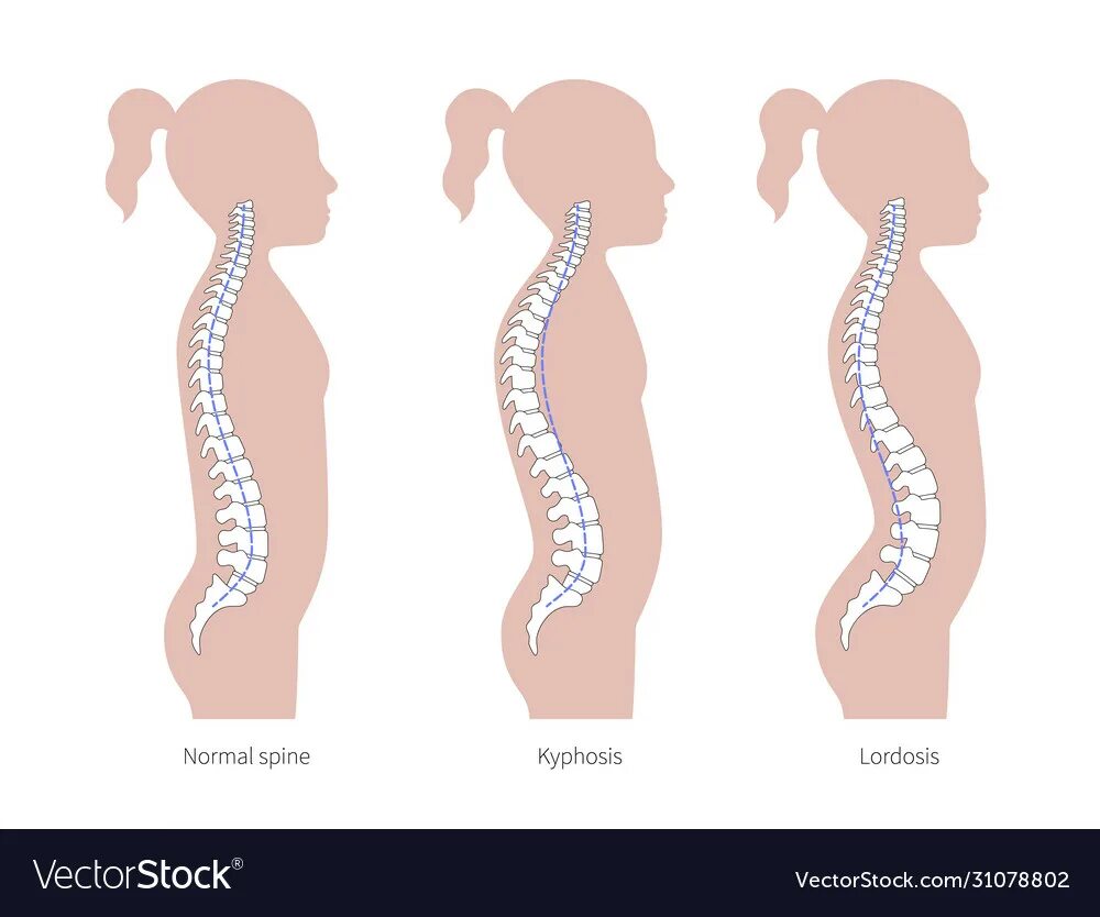 Лордозы и кифозы позвоночника анатомия. Лордоз и кифоз позвоночника. Кифоз и лордоз поясничного отдела. Искривление позвоночника кифоз и лордоз.