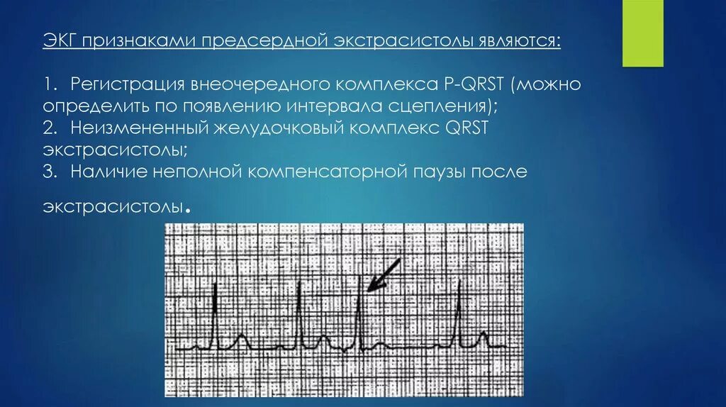 ЭКГ-признаки предсердной экстрасистолы. Предсердная экстрасистолия на ЭКГ. ЭКГ при предсердной экстрасистолии. Желудочковая экстрасистолия на ЭКГ. Экстрасистолы ощущения