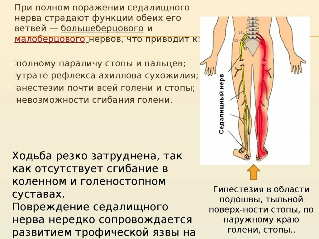 Болит спина и тянет ногу. Как расположен седалищный нерв. Поражение седалищного нерва симптомы. Заземление седалищный нерв. Ущемление седалищного нерва симптомы.