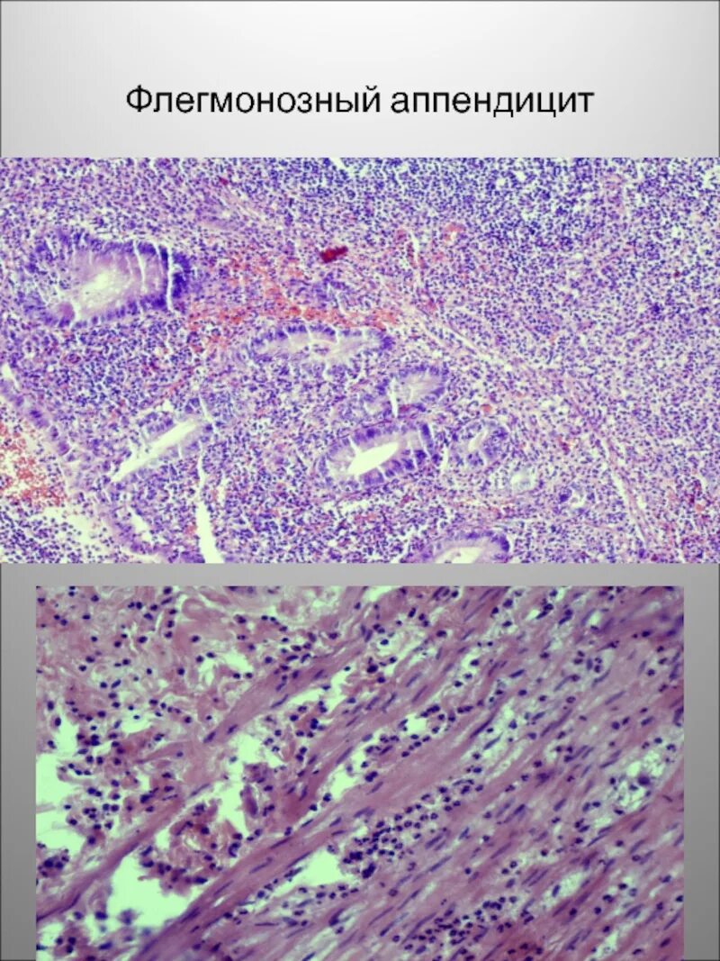 Флегмонозно язвенный аппендицит патанатомия. Флегмонозно-язвенный аппендицит гистология. Флегмонозный холецистит гистология. Флегмонозный аппендицит. Периаппендицит..