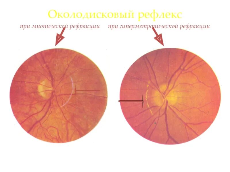 Миопический конус глазное дно. Розовый рефлекс глазного дна. Миопический конус и стафилома. Световые рефлексы глазного дна.