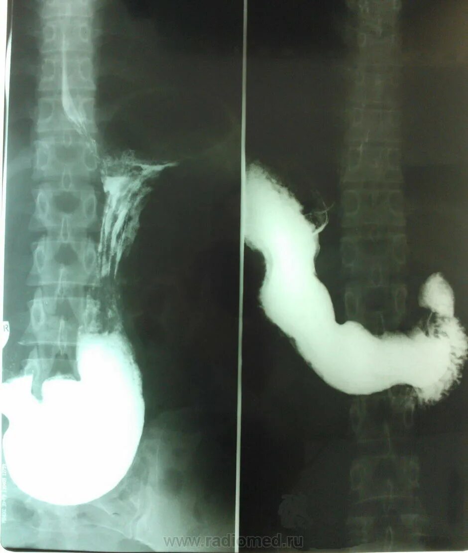 Рентген с барием пищевода и желудка подготовка. Безоары в желудке рентген. Рентген пищевода и желудка.