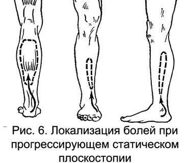 Плоскостопие сильно болят ноги