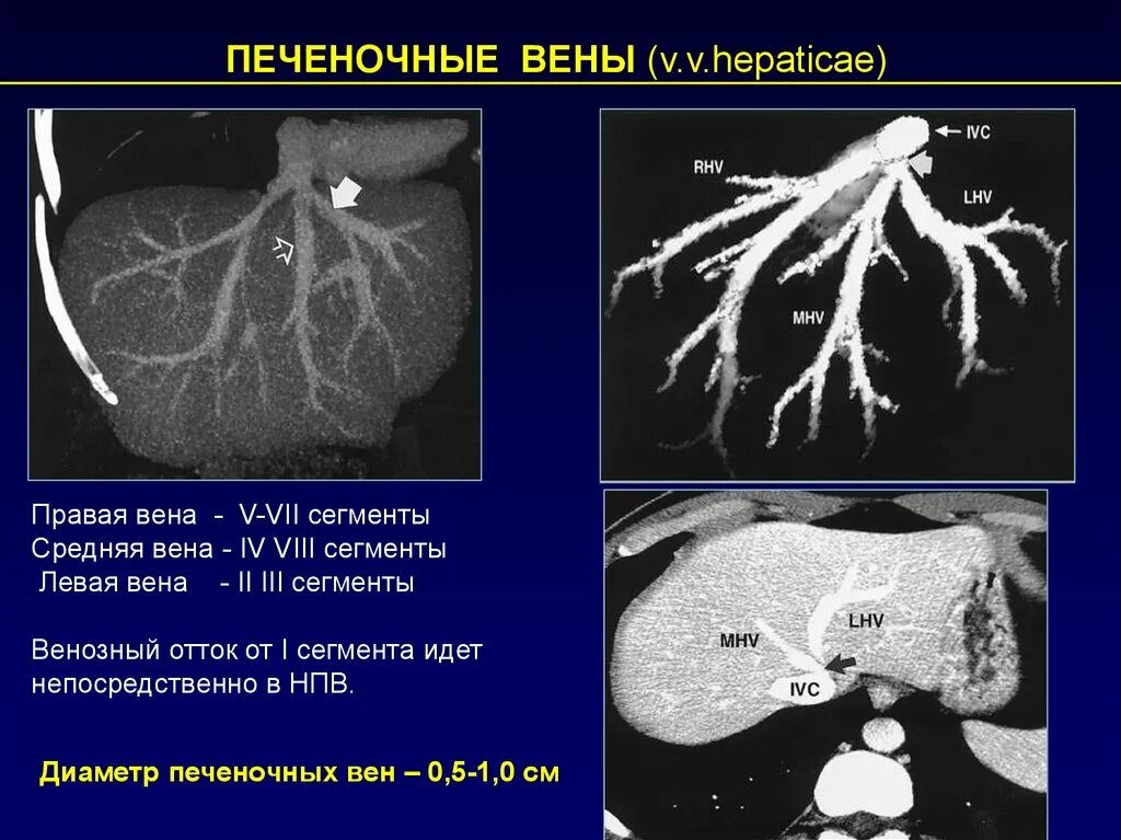 Тромбоз воротной вены на кт. Анатомия печеночных вен. Печеночные вены анатомия кт. Тромбоза вен печени