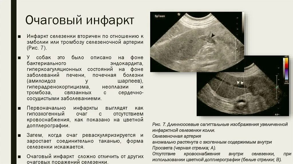 Зона инфаркта селезенки на УЗИ. Исход инфаркта селезенки УЗИ.