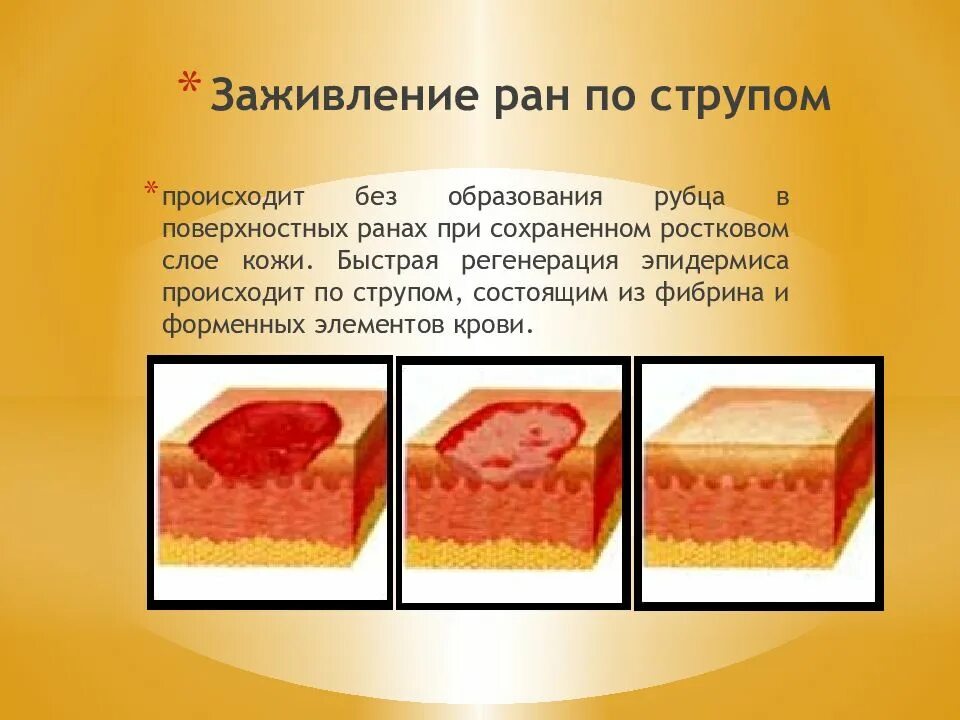 Раны и раневой процесс - презентация