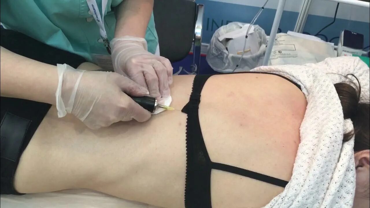 Укол карбокси. Уколы карбокситерапия для позвоночника. Карбокситерапия со2 газом. Карбокситерапия инъекционная для тела. Карбокситерапия уколы углекислым газом.