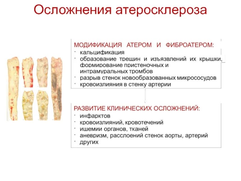 Атеросклероз аорты что это такое простыми. Наиболее частые последствия и осложнения атеросклероза. облитерирующий атеросклероз осложнения. осложнения артериосклероза. перечислите осложнения атеросклероза.