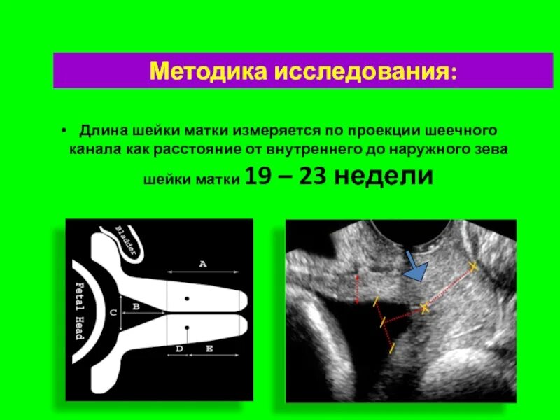 Внутренний зев воронкообразно
