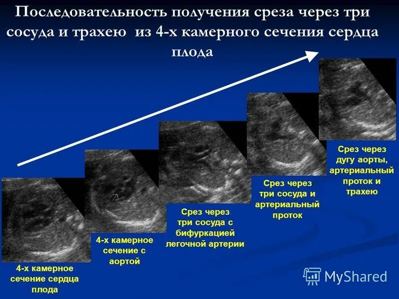 Срез сосуда. Четырехкамерный срез сердца плода. Срез через 3 сосуда у плода норма. Срез через три сосуда плода.