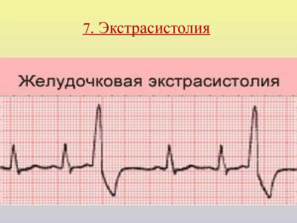 Желудочковые экстрасистолы. Злокачественная желудочковая экстрасистолия. Идиопатическая желудочковая экстрасистолия. Идиопатические желудочковые экстрасистолы. Типы желудочковых экстрасистол