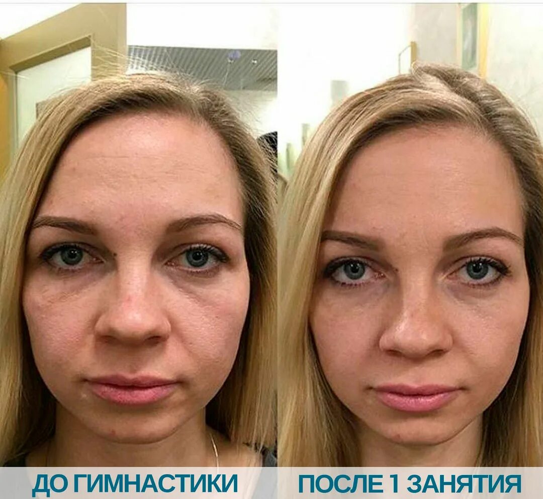 Бурдюг разоблачение до и после пластики. Фейс фитнес анастасия бурдюг. анастасия бурдюг до и после гимнастики. курс супер лицо анастасия бурдюг упражнения для шеи.