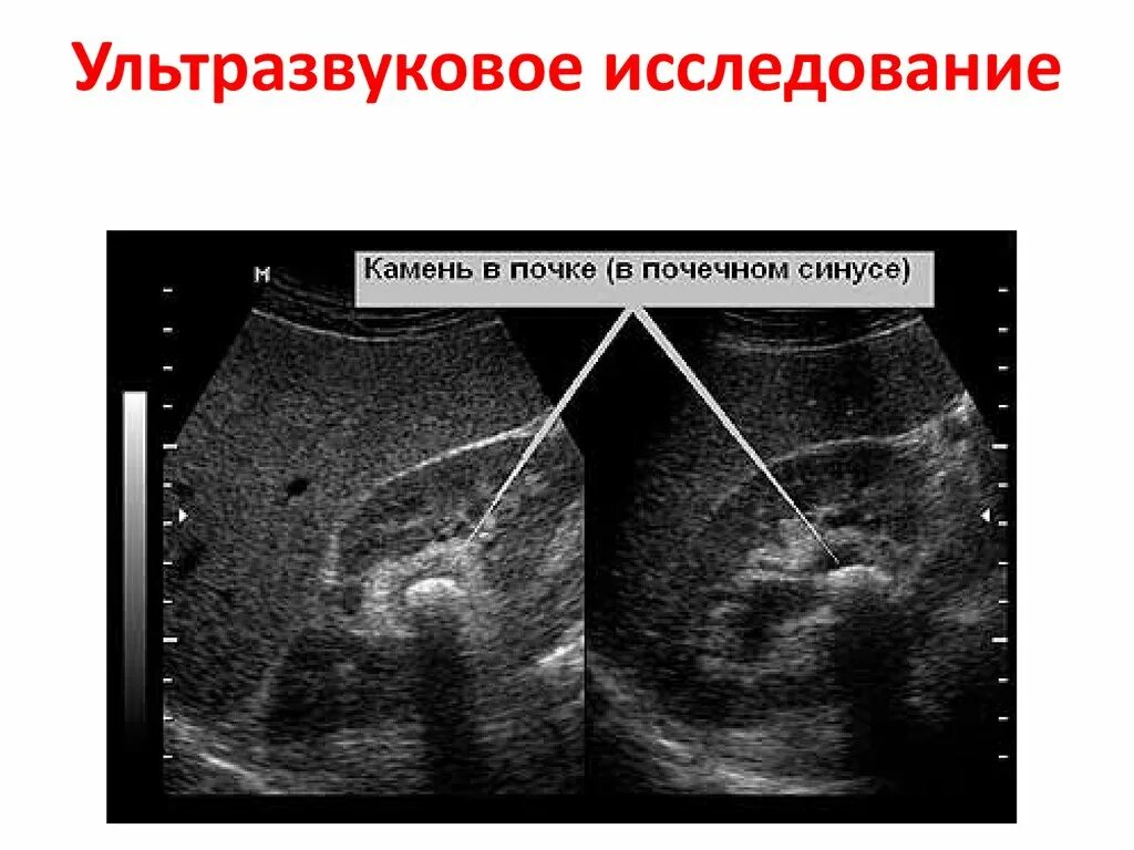 Конкременты в почках на УЗИ что это такое. Мочекаменная болезнь снимки УЗИ. УЗИ почек мочекаменная болезнь. Мкб на УЗИ почек. Узи почка не видна