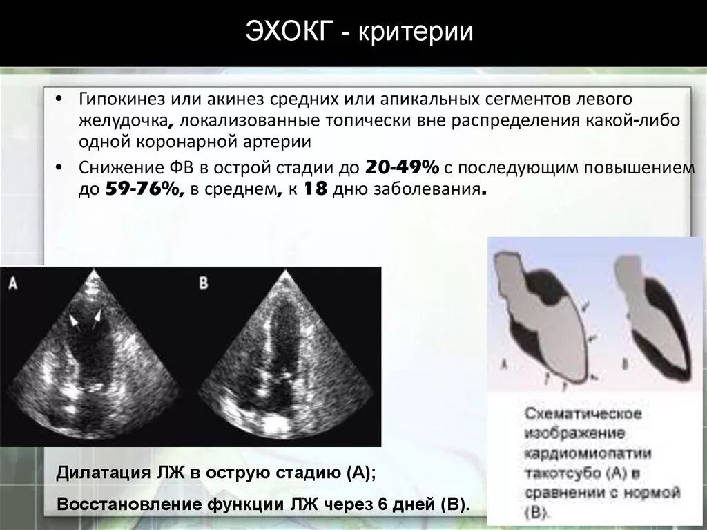 Локальная сократимость левого желудочка. Гипокинез сегментов левого желудочка. ДКМП ЭХОКГ критерии. Кардиомиопатии на ЭХОКГ. Зоны акинезии на ЭХОКГ.