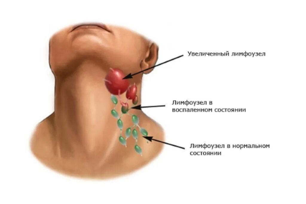 Лимфоузел под челюстью зуб. Лимфоузел под челюстью зуб
