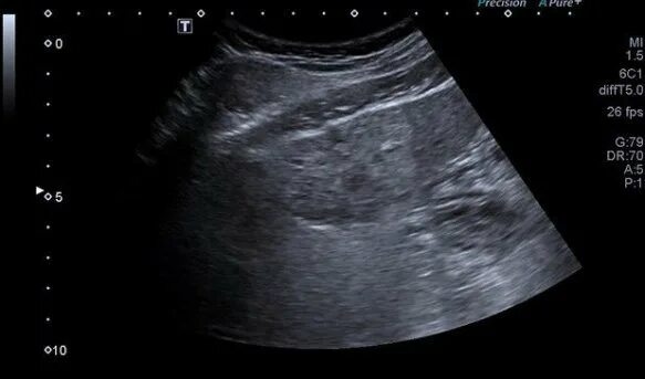 Узи признаки кальцинатов печени. Кисты кальцификаты печени. Кальцинаты в печени диагноз. Альвеококковые кисты в печени. Кальцинат паренхимы печени.