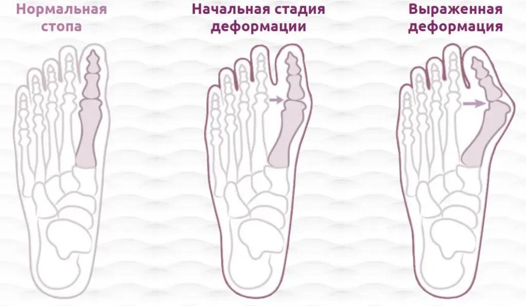Деформация стопы у взрослых лечение гимнастика вальгусная. Вальгусная деформация стопы анатомия. вальгусная деформация стопы степени.