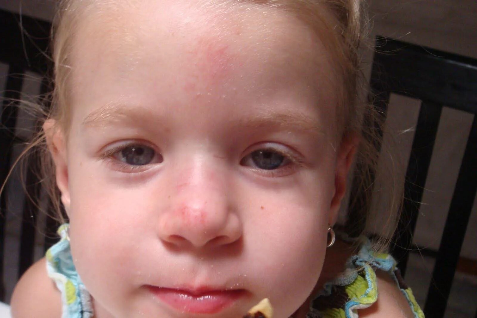 перелом переносицы у ребенка. перелом костей носа симптомы. перелом костей носа стадии. смещение носа у ребенка. перелом костей носа без смещения костных отломков.