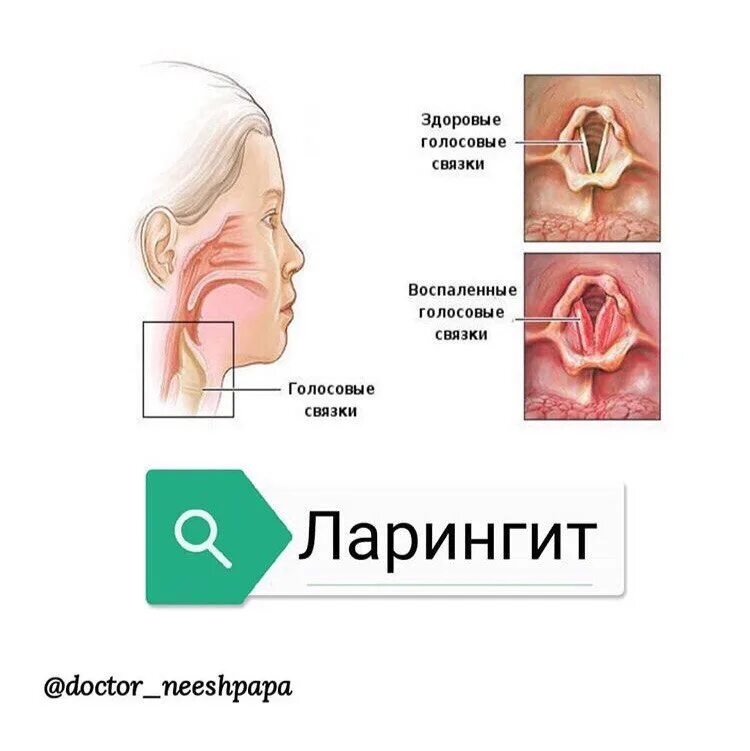 Голосовые связки ларингит. Катаральный ларингит ларингоскопия. Факторы острого ларингита. Вазомоторный ларингит. Как лечить голосовые