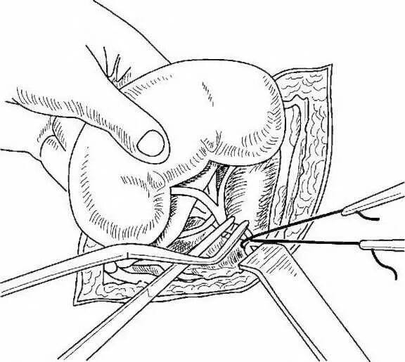 вырвать орган. эндоскоп хирургический. эктомия стомия резекция. полное удаление органа называется. эктомия это определение в хирургии.