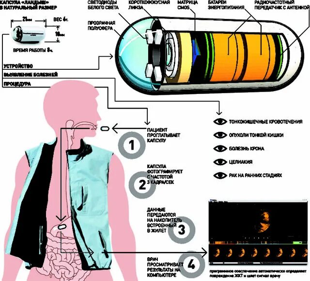 Капсула исследование жкт. Капсула с камерой для исследования жкт. таблетка камера для обследования желудка. капсульная эндоскопия тонкой кишки.